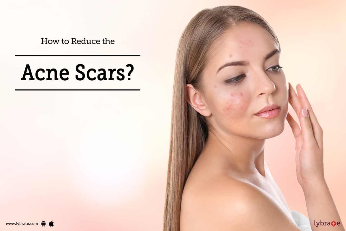 How to Reduce the Acne Scars? - By Dr. Sangeeta Varma | Lybrate