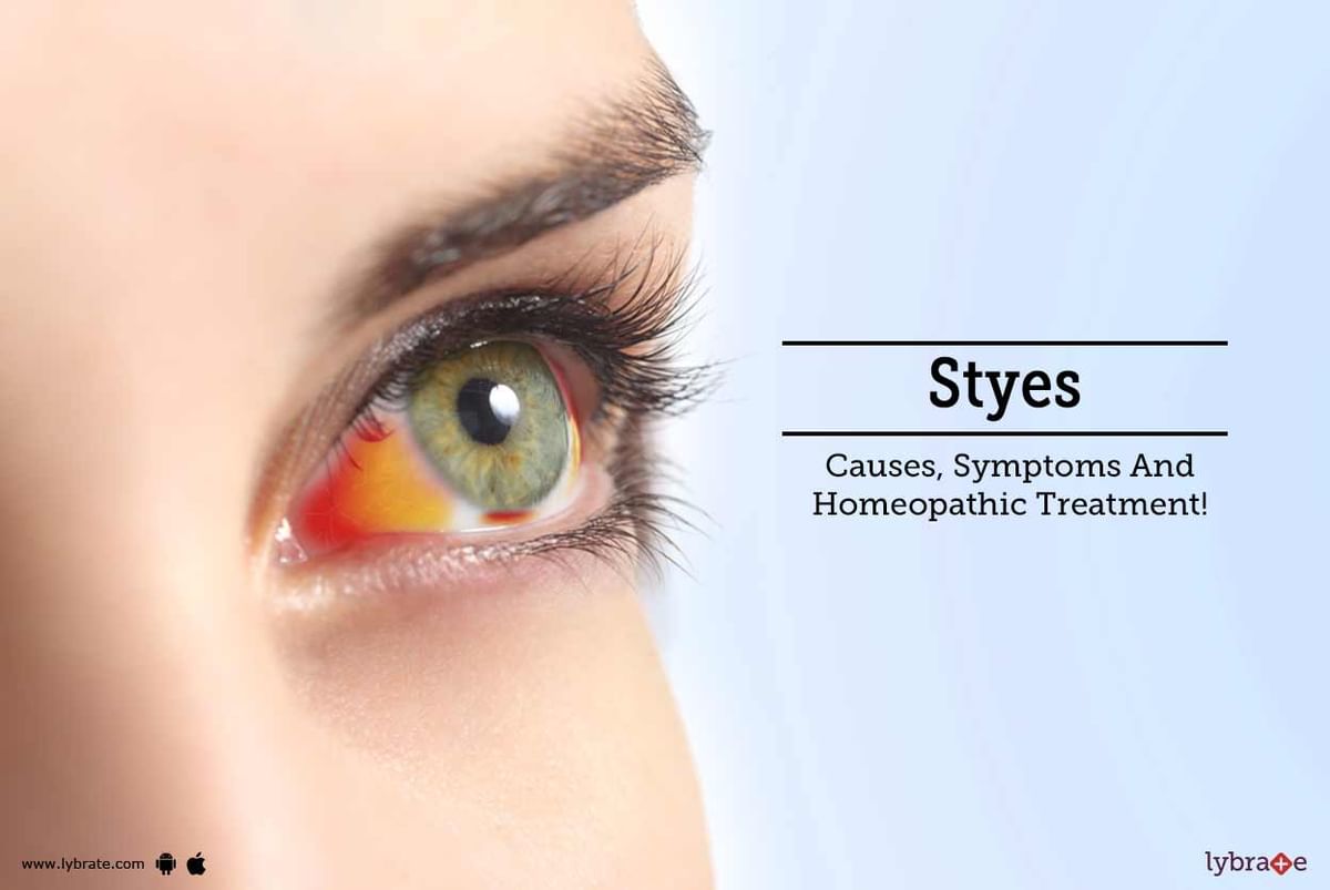 Styes Causes Symptoms And Homeopathic Treatment By Dr Vinod Kumar Lybrate