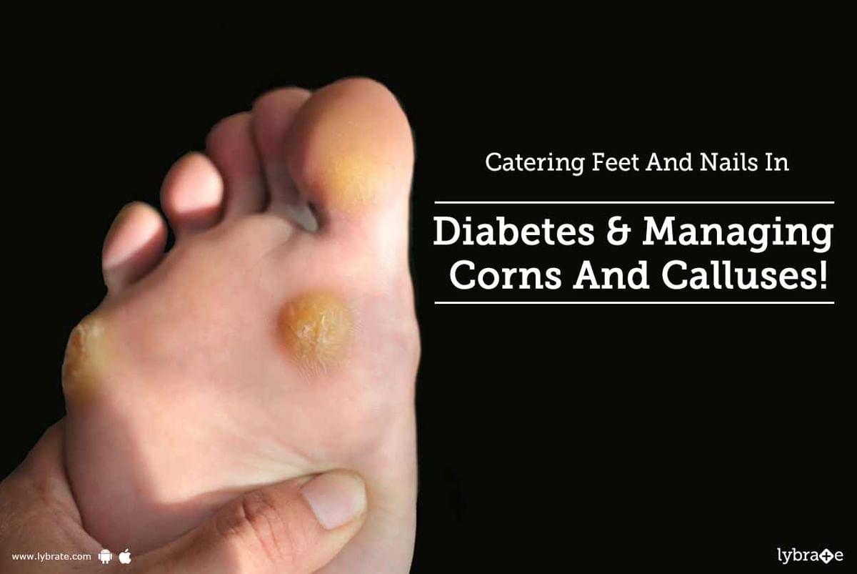 Diabetes Foot Care: How to File Buildup of Hard Skin or Corns -  HealthXchange