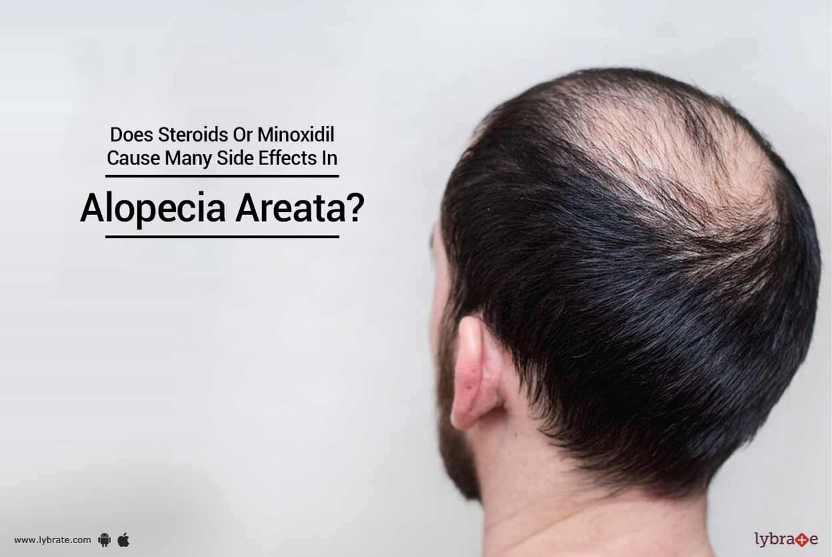Does Steroids Or Minoxidil Cause Many Side Effects In Alopecia Areata? |  Lybrate