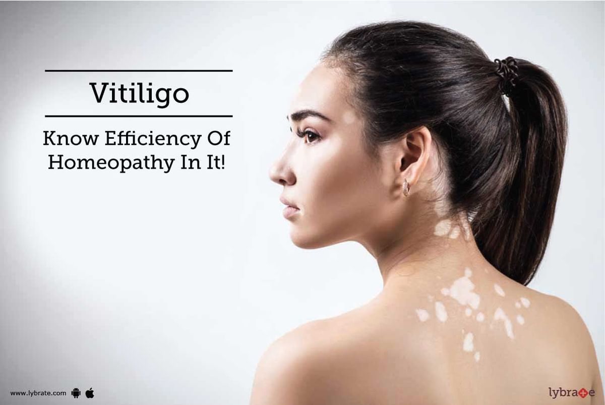 Vitiligo Know Efficiency Of Homeopathy In It By Dr Jayvirsinh Chauhan Lybrate 6235