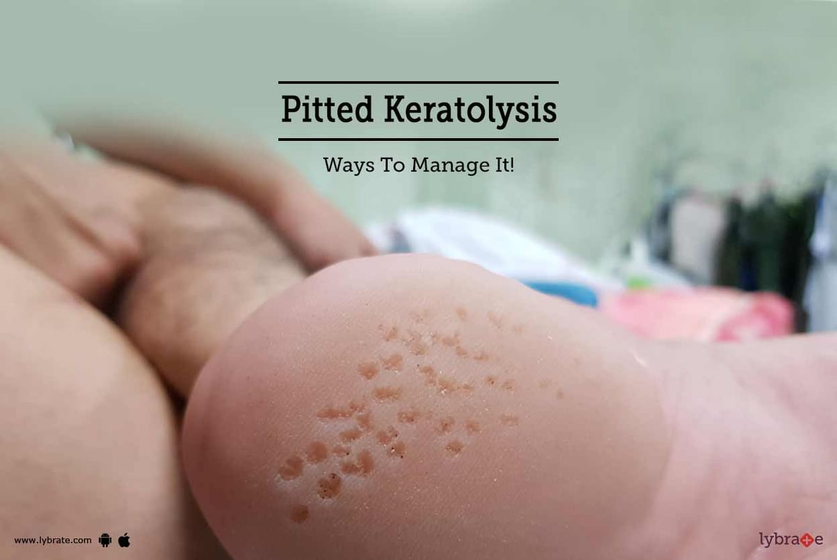 Pitted Keratolysis (+ Foot Sweating): Treatment at Home!