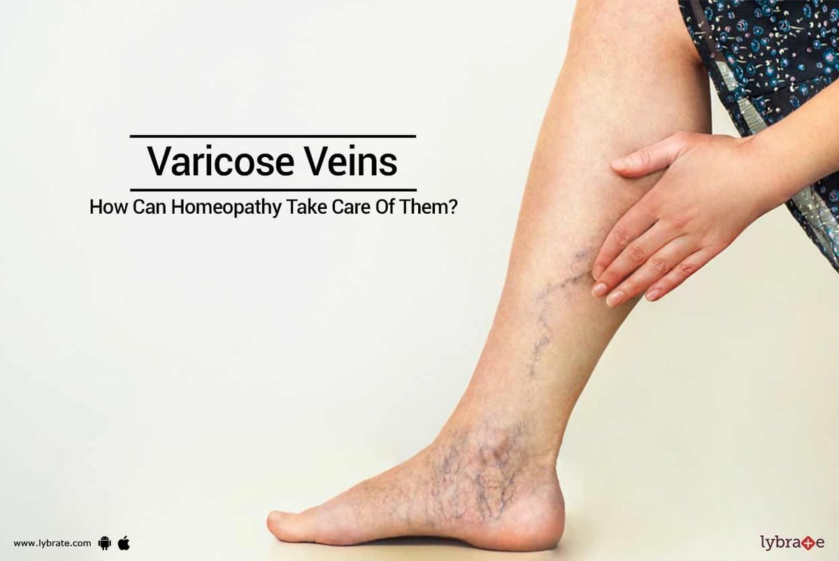 Varicose Veins - How Can Homeopathy Take Care Of Them? - By Dr ...