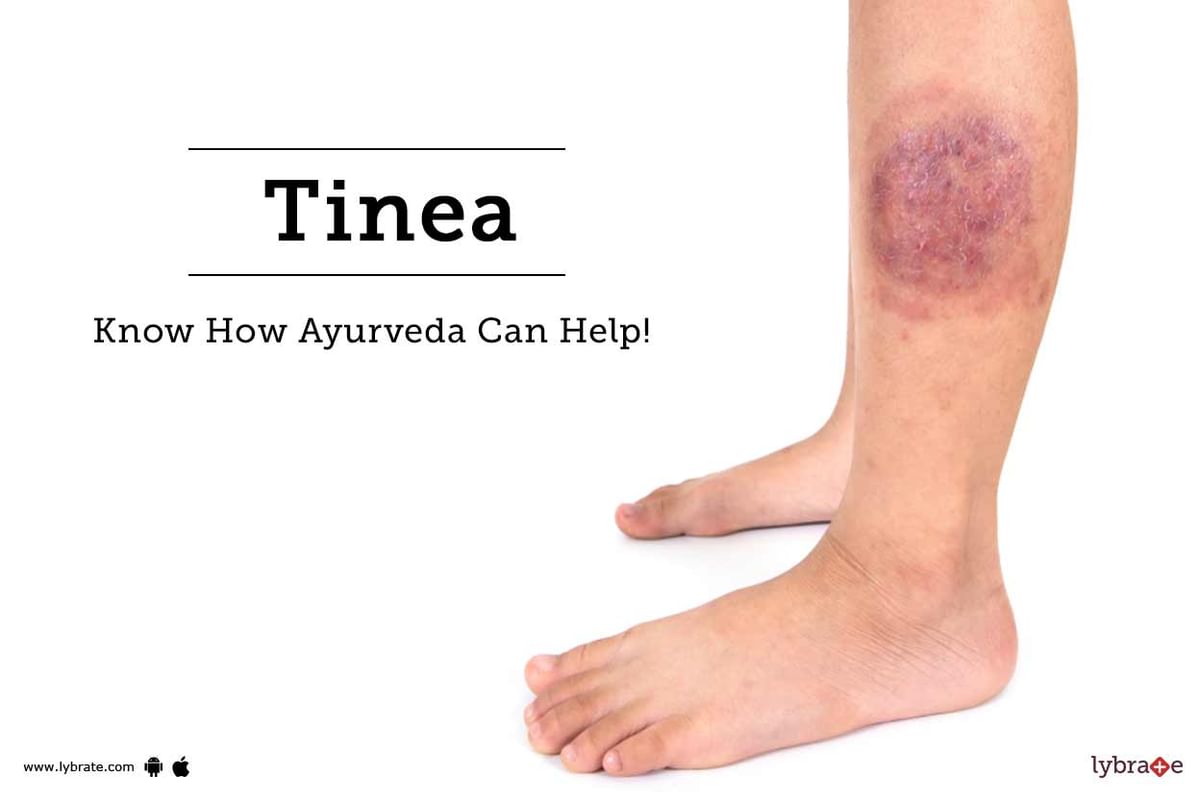 Tinea - Know How Ayurveda Can Help! - By Shanta Ayurveda Hospital