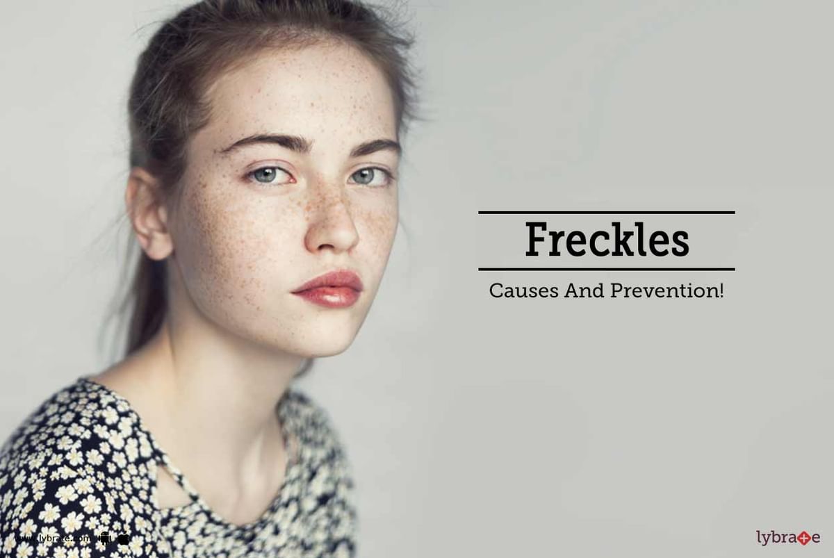 Freckles - Causes And Prevention! - By Dr. Dora Chopra | Lybrate