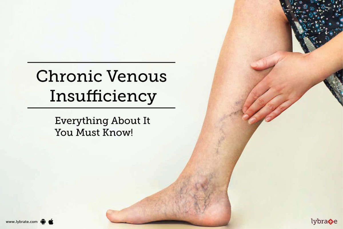 Chronic Venous Insufficiency - Everything About It You Must Know! - By Dr.  Mohd Zeeshan Hakim