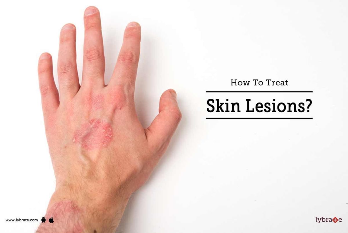 how-to-treat-skin-lesions-by-dr-salma-siddiqui-lybrate