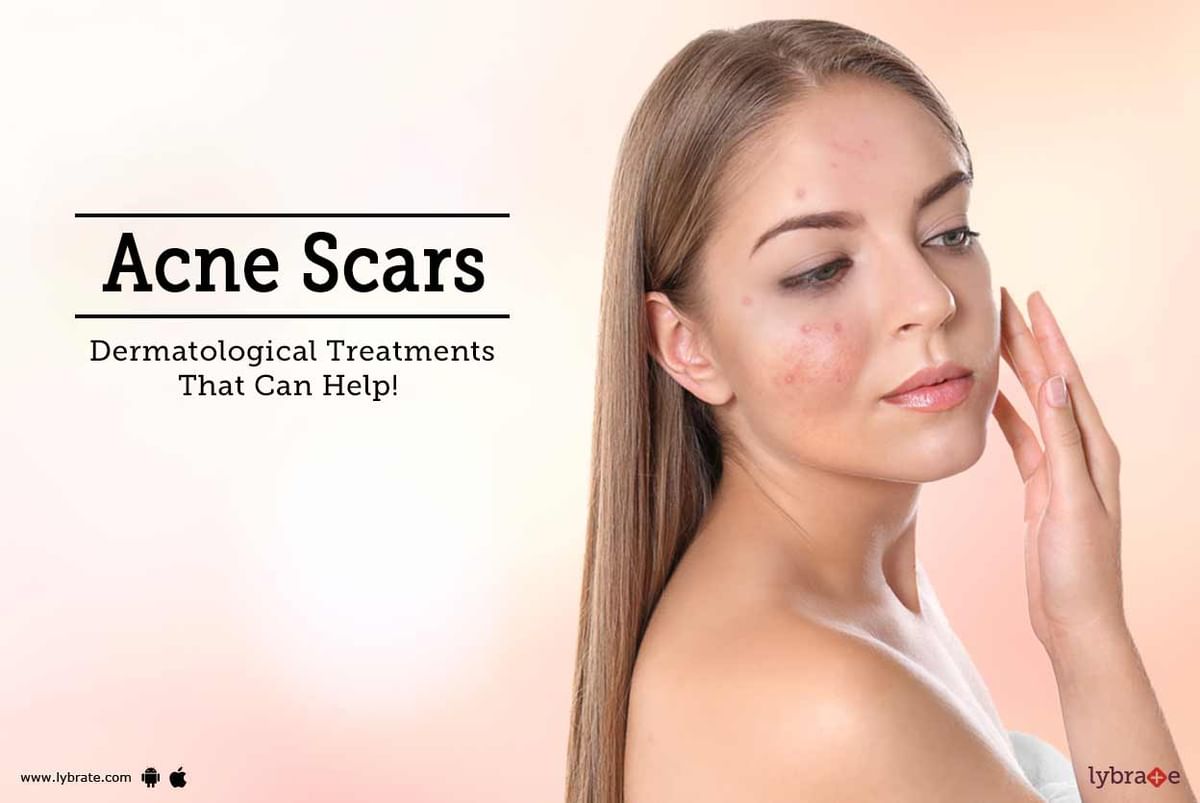 Acne Scars - Dermatological Treatments That Can Help! - By Clinic ...