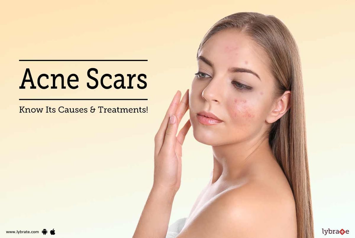 Acne Scars: Know Its Causes & Treatments! - By Dr. Priyanka Dasari ...