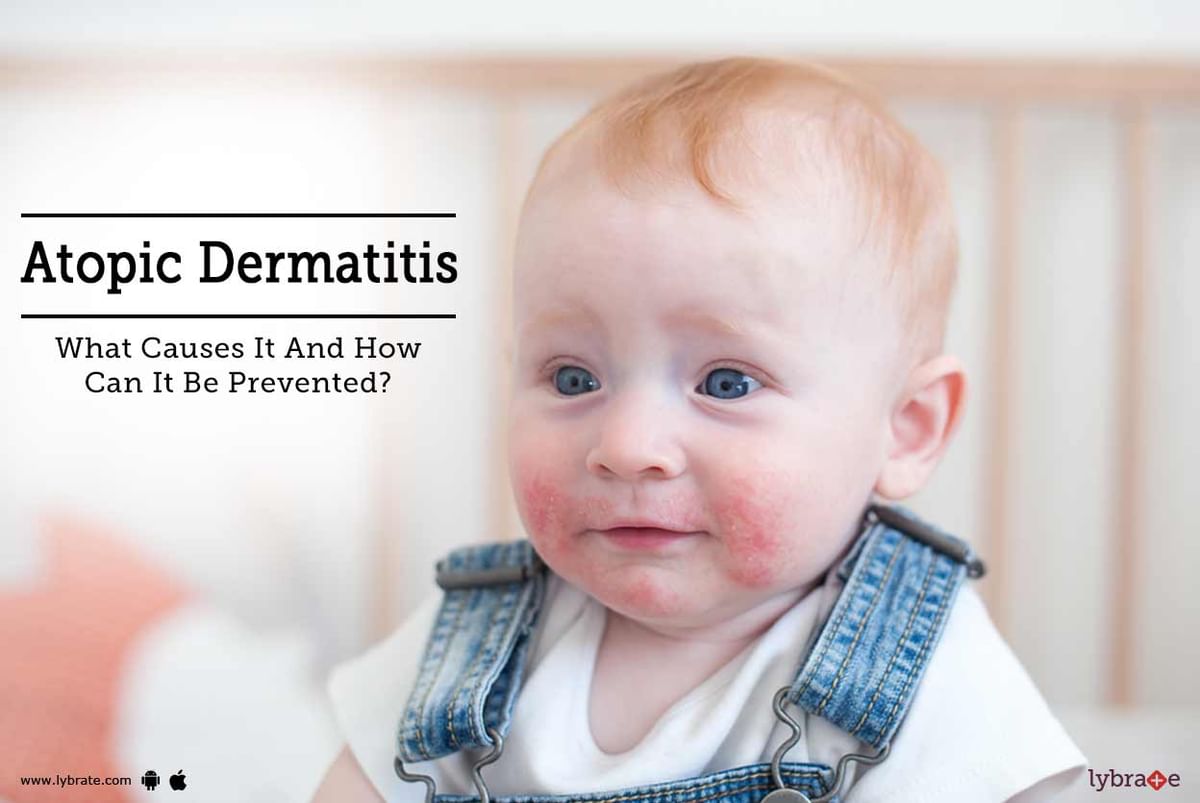 Atopic Dermatitis - What Causes It And How Can It Be Prevented? - By Dr ...