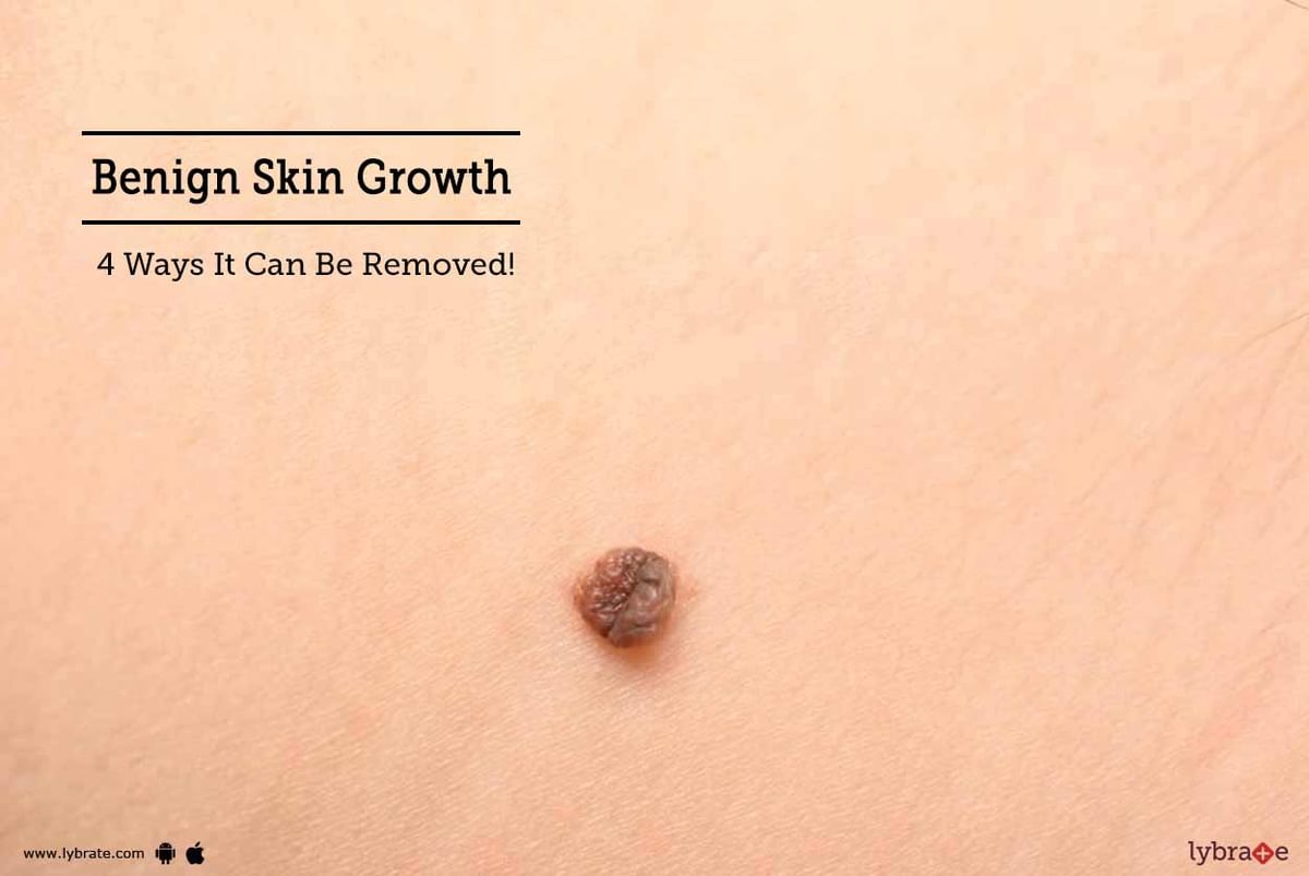 Benign Skin Growth 4 Ways It Can Be Removed By Dr Smita Priyadarshni Lybrate