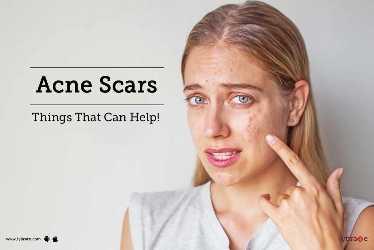 Acne Scars - Things That Can Help! - By Dr. Prashant Sinha | Lybrate