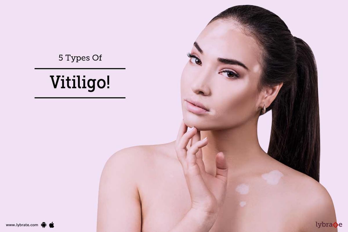 5 Types Of Vitiligo By Sakhiya Skin Clinic Private Limited Lybrate 