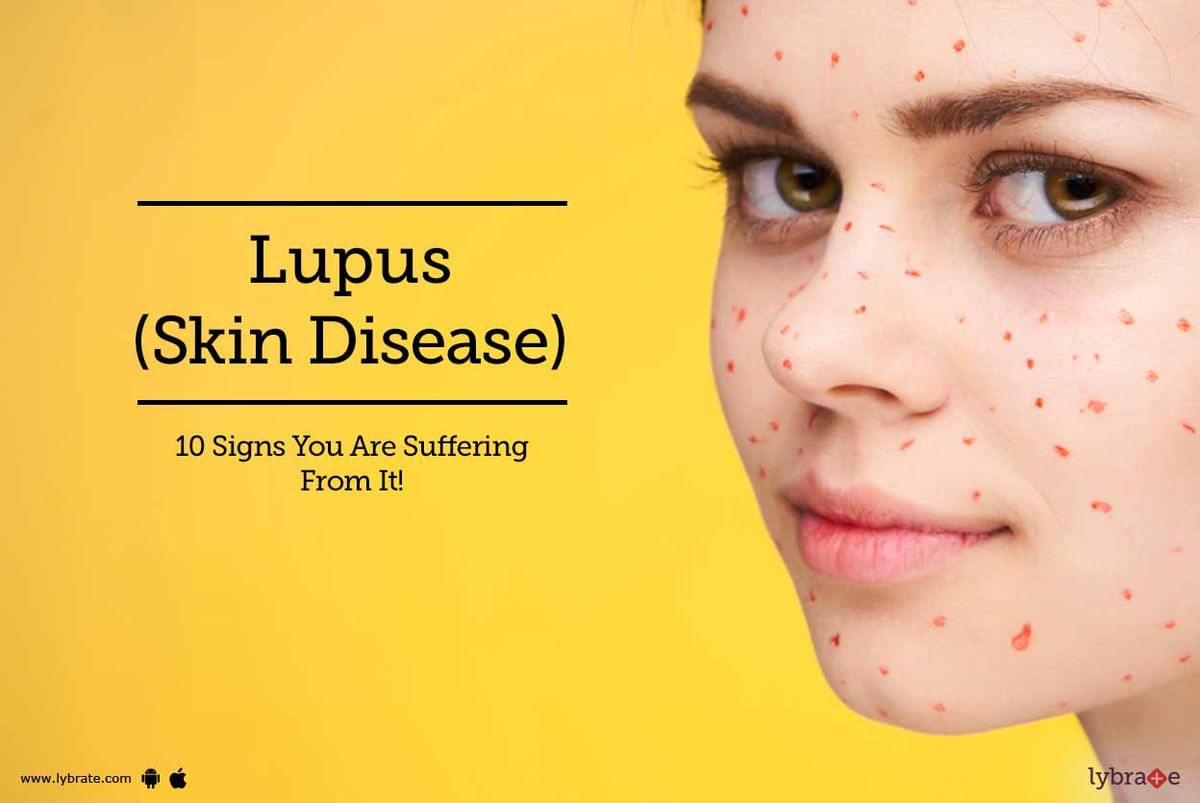 Lupus Skin Disease 10 Signs You Are Suffering From It By Dr 