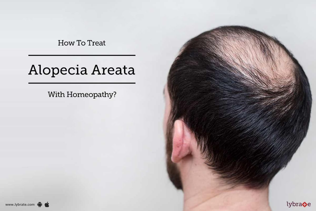 How To Treat Alopecia Areata With Homeopathy? - By Dr. Shrey Bharal |  Lybrate