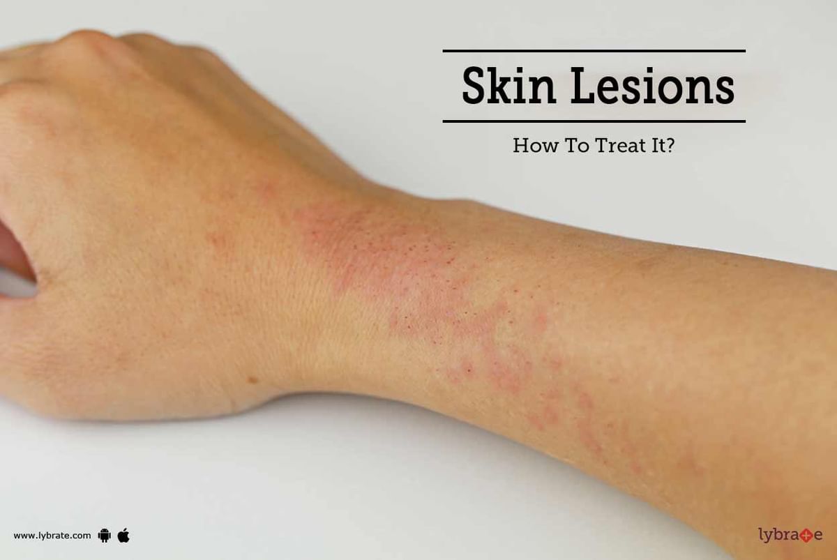 Skin Lesions - How To Treat It? - By Dr. Vikram Gidwani | Lybrate