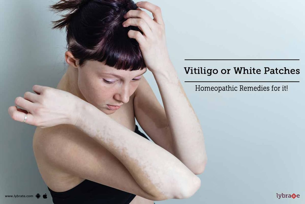 Homeopathic Medicine for Vitiligo or White Patches Treatment - By Dr.  Jeevan Kopparad | Lybrate