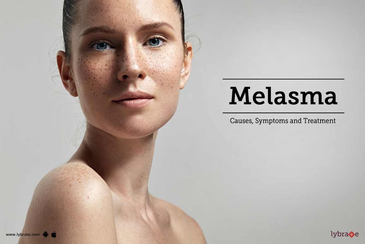 Melasma: Causes, symptoms, pictures & treatment