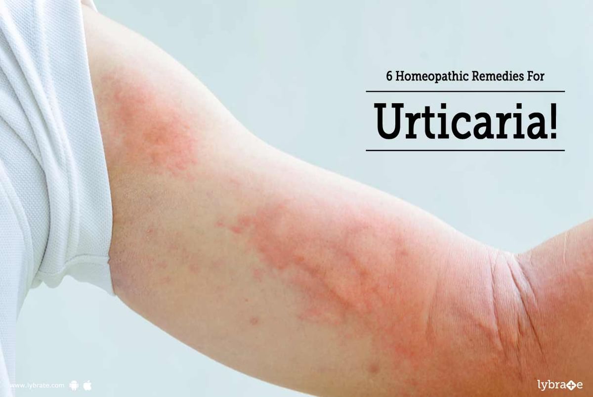 6 Homeopathic Remedies For Urticaria By Dr Alok Kumar Lybrate 