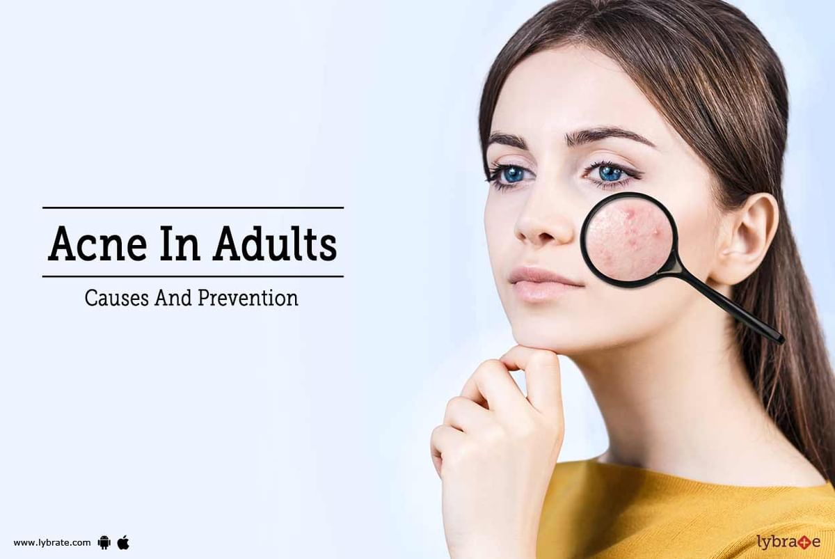 Acne In Adults - Causes And Prevention - By Dr. Jangid | Lybrate