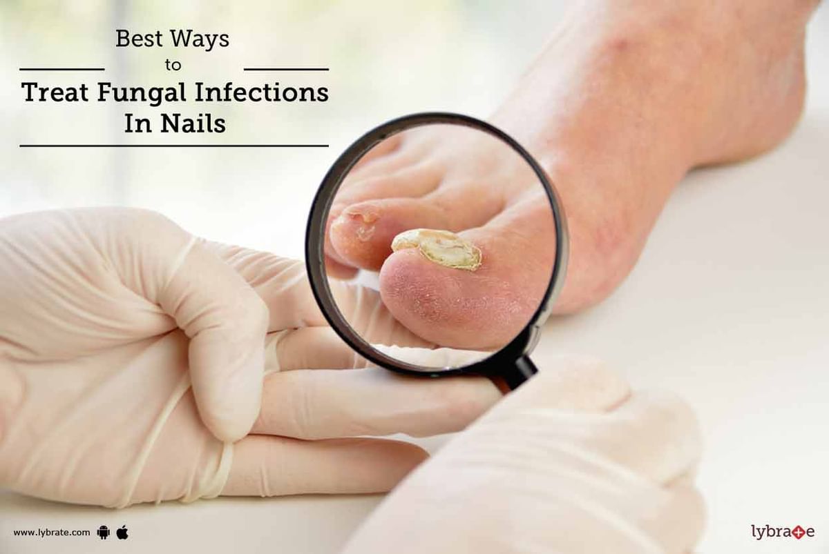 Understanding Fungal Nail Infections and Best Treatment Options