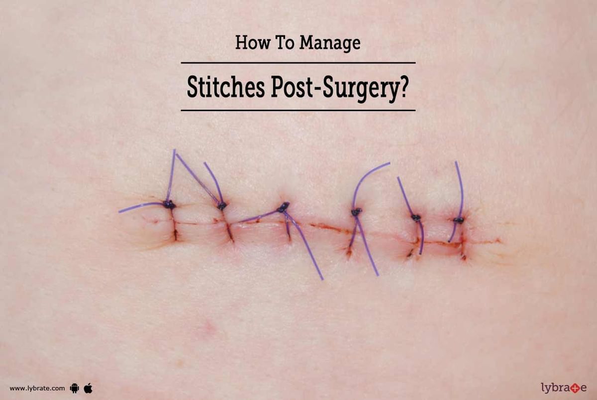 How To Manage Stitches PostSurgery? By Dr. C.Prashanth Lybrate