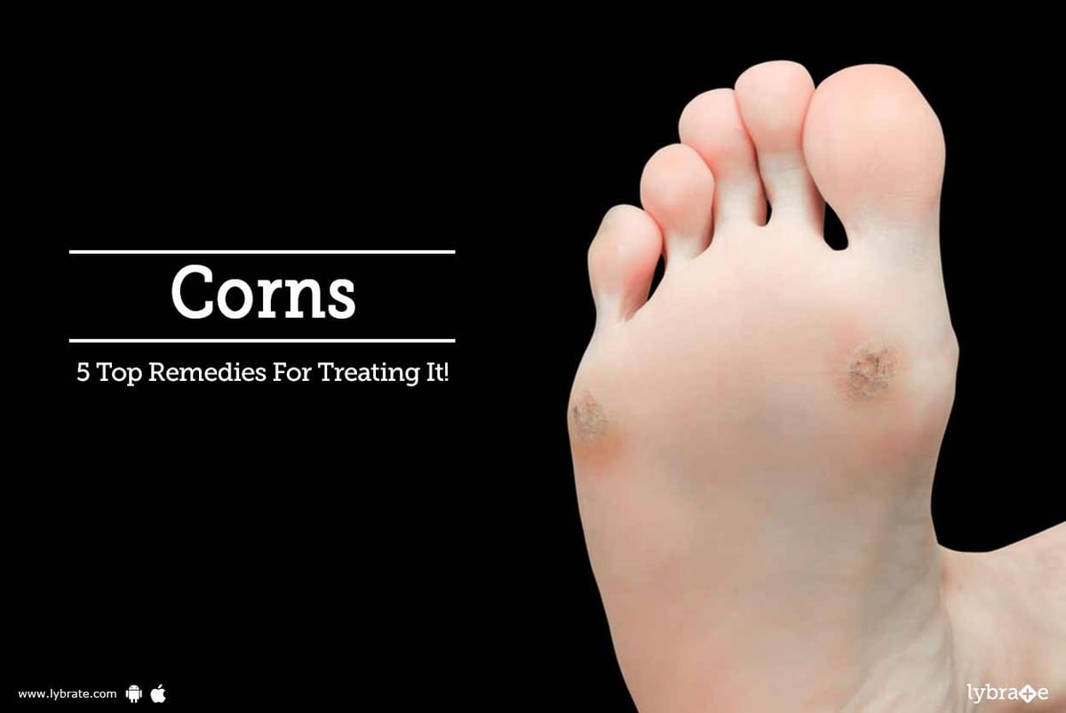 Homeopathic medicine for corns on soles online