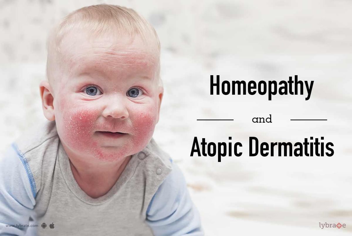 Homeopathy And Atopic Dermatitis By Dr Arpit Chopra Jain Lybrate