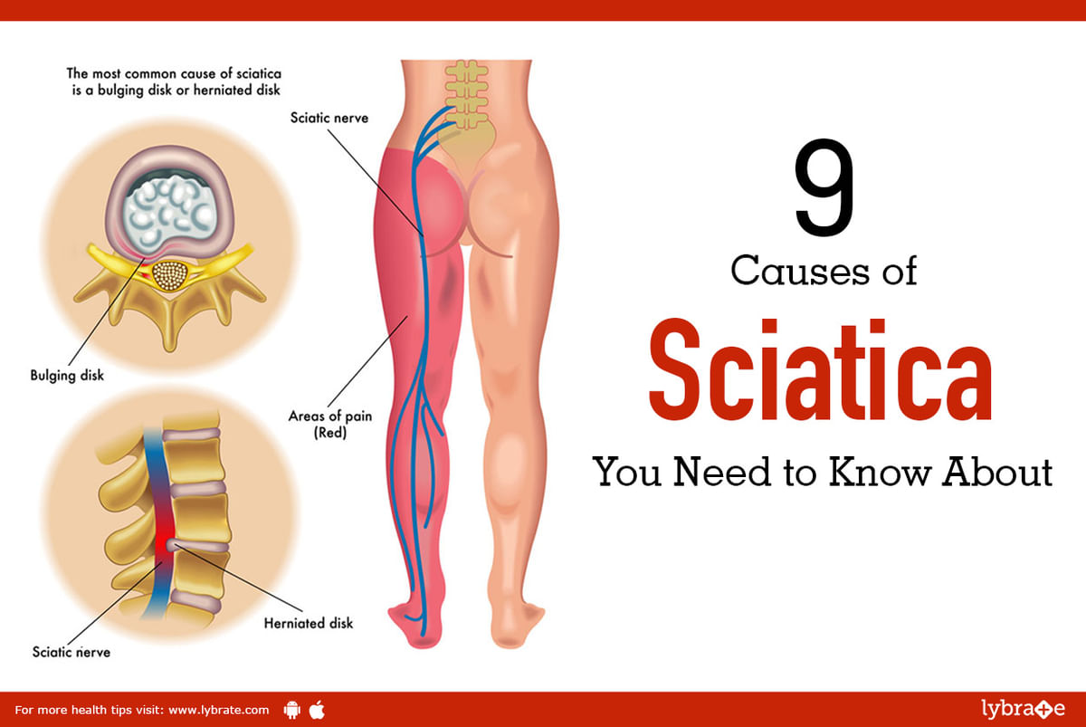 Good Sciatica Pain Relief: Causes Of Sciatica And Sciatic Nerve