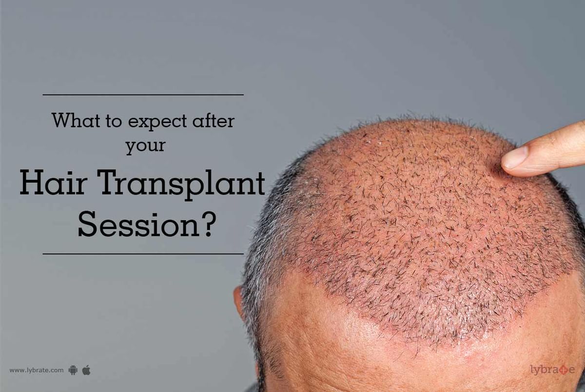 What To Expect After Your Hair Transplant Session? - By Dr. Ajaya Kashyap |  Lybrate
