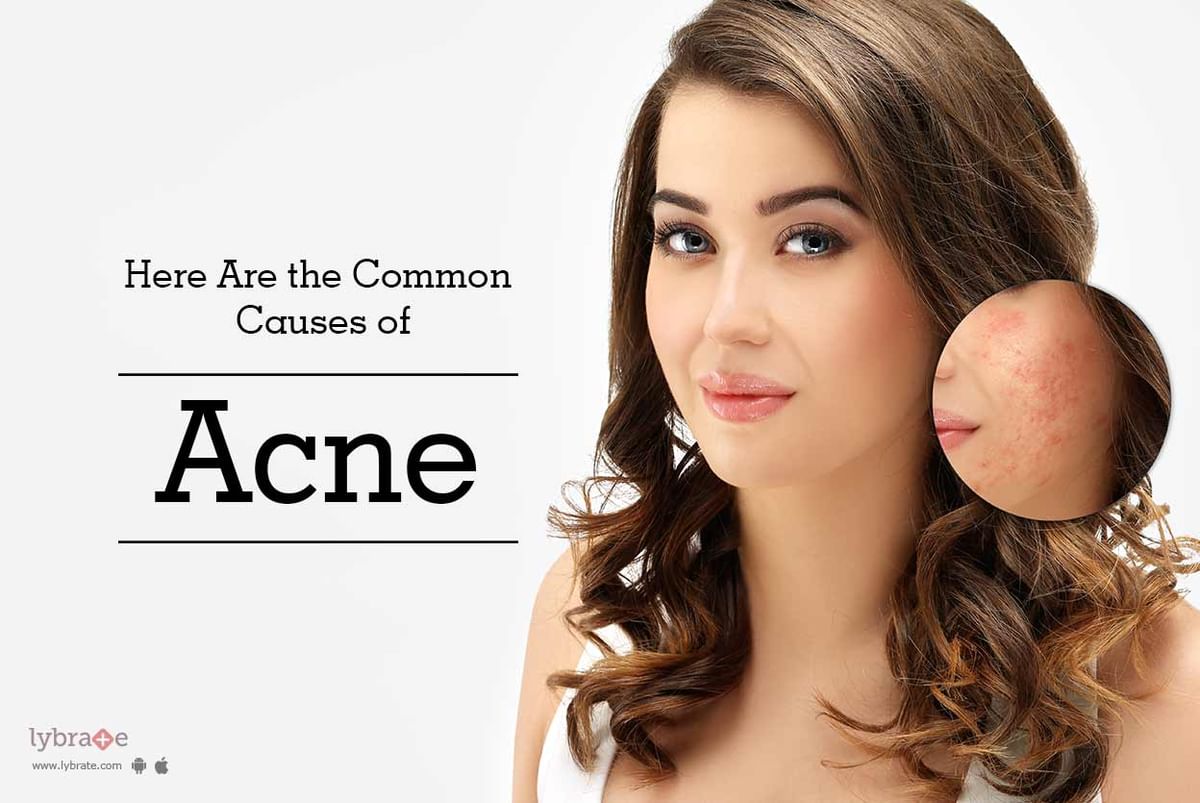 Here Are the Common Causes of Acne - By Dr. Akhilendra Singh | Lybrate