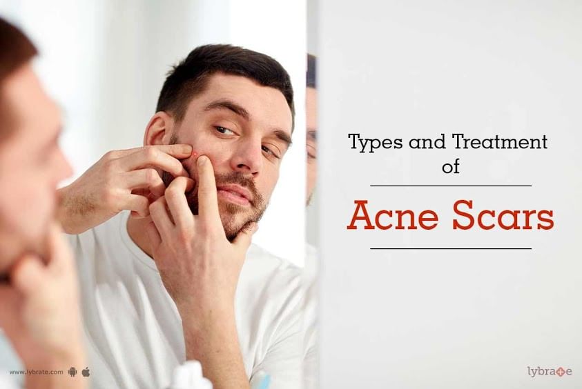 Types And Treatment Of Acne Scars - By Dr. Anju Kollare | Lybrate