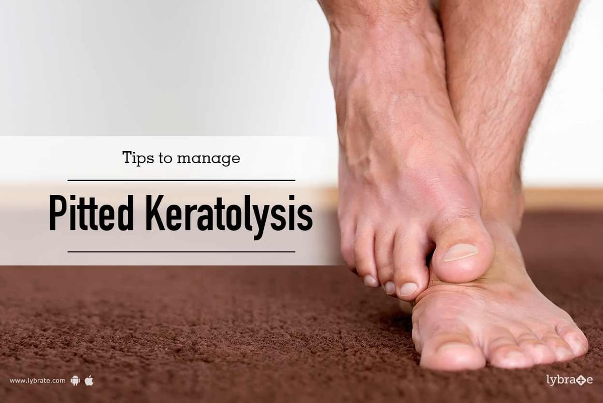Tips to Manage Pitted Keratolysis - By Dr. Sandesh Gupta | Lybrate
