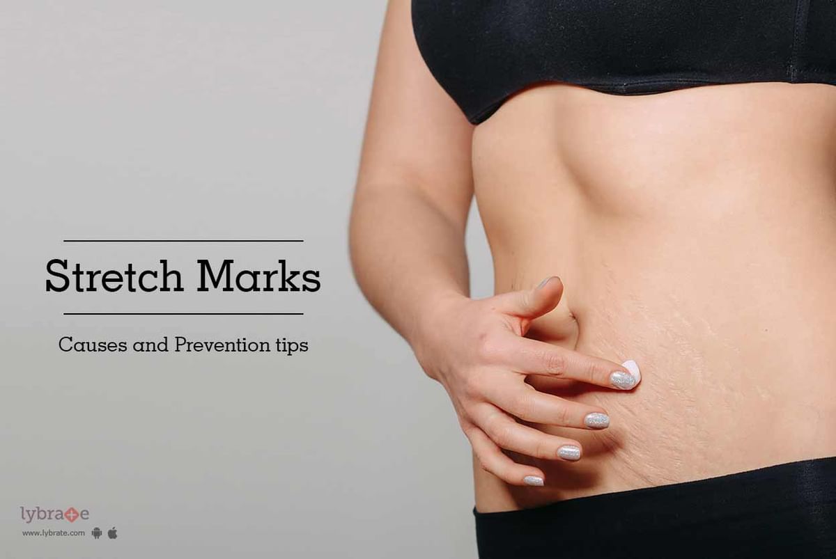Why Losing Weight Causes Stretch Marks - Plastic Surgery Skin Clinic