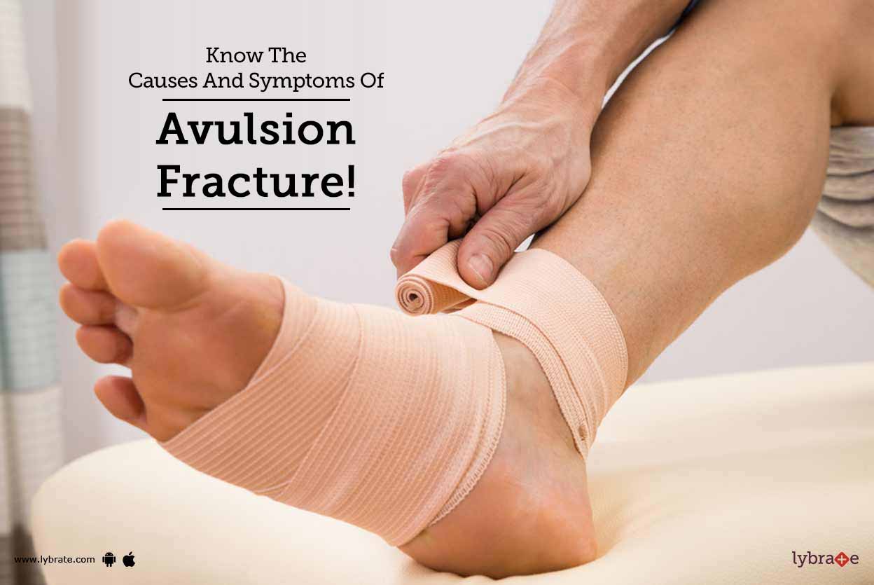 Know The Causes And Symptoms Of Avulsion Fracture! By Dr. Rahul