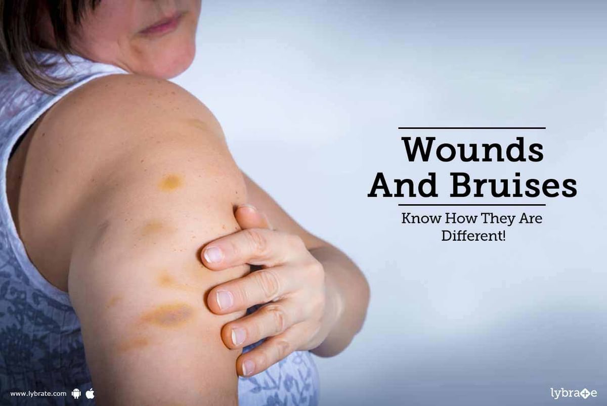 Wounds And Bruises - Know How They Are Different! - By Dr. Brahmesh ...