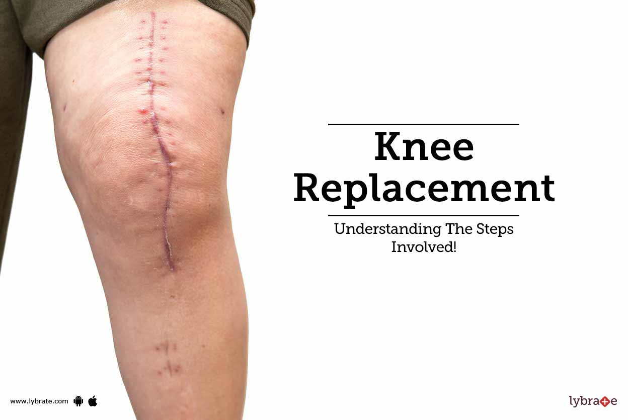 Knee Replacement Understanding The Steps Involved! By Dr. Gaurav