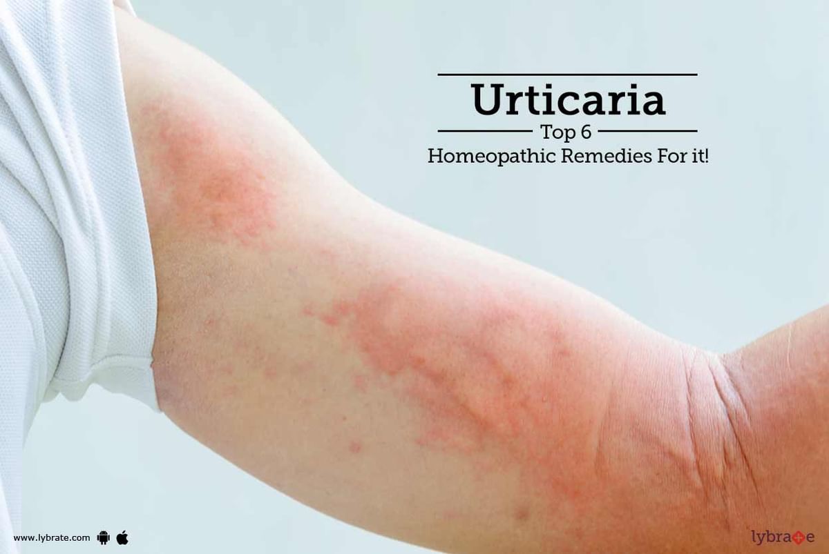 Urticaria Top 6 Homeopathic Remedies For It By Dr Minhaz Nisar Lybrate