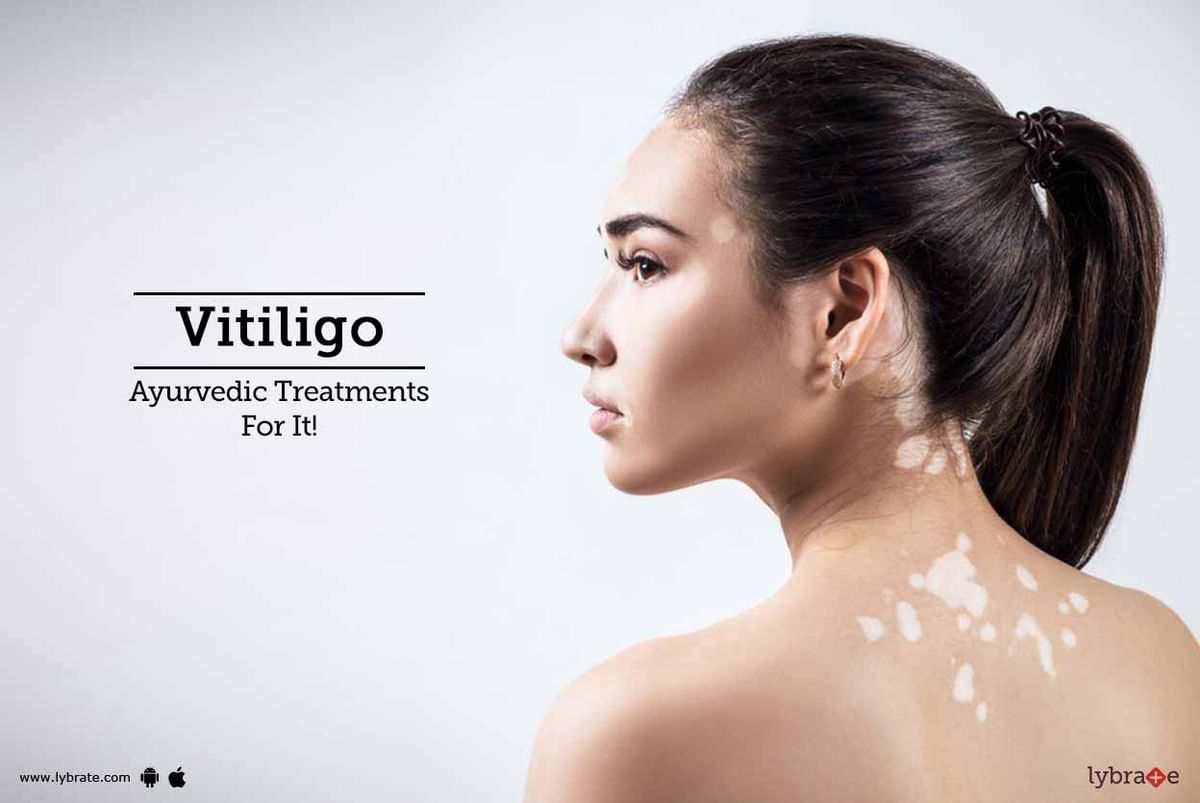 Vitiligo - Ayurvedic Treatments For It! - By Dr. Aditi Shrivastav | Lybrate