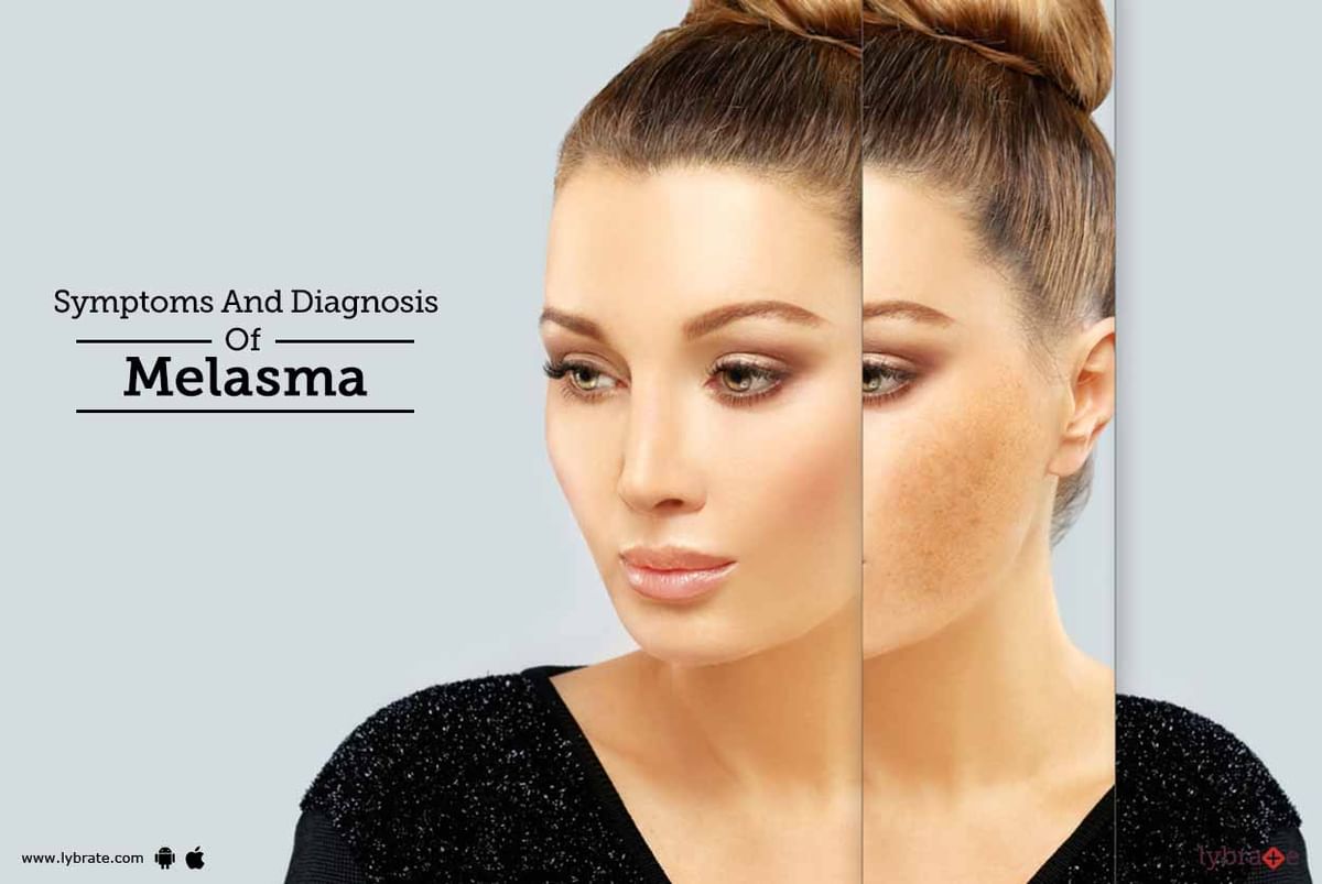 Symptoms And Diagnosis Of Melasma By Dr Nitin Jain Lybrate