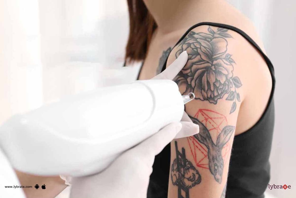 Tattoo Removal Blisters  tattoo art gallery