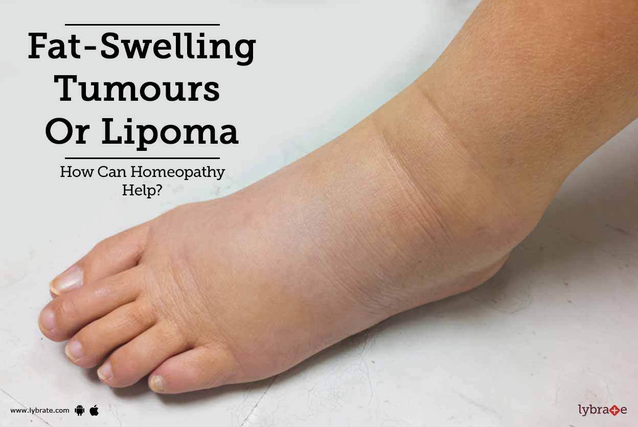 FatSwelling Tumours Or Lipoma How Can Homeopathy Help? By Dr. S.K