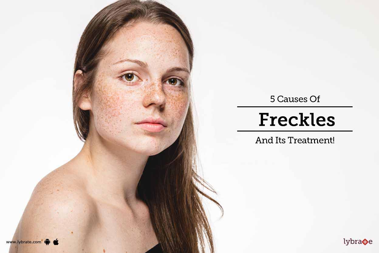 5 Causes Of Freckles And Its Treatment! By Dr. Sunil Sabhnani Lybrate