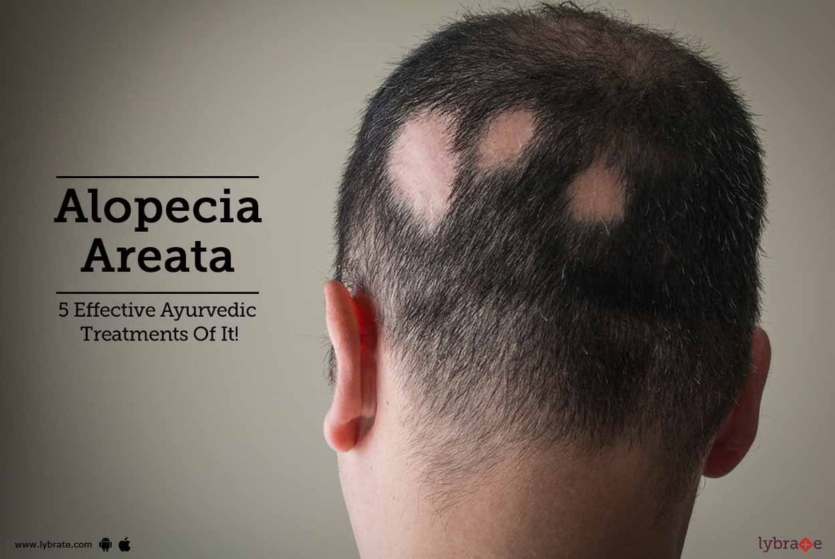 Alopecia Areata - 5 Effective Ayurvedic Treatments Of It! - By Dr. Rohit  Shah | Lybrate