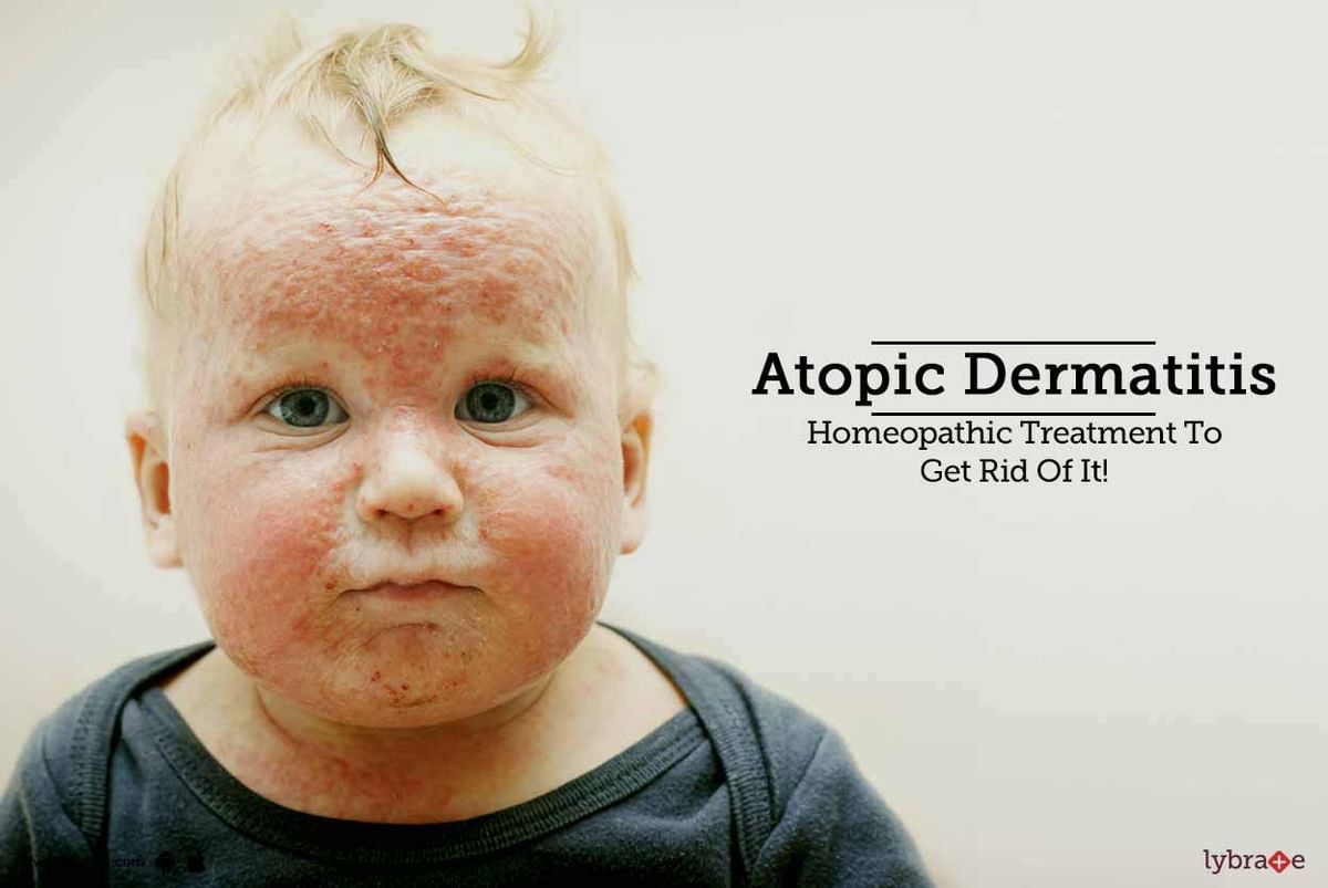 Atopic Dermatitis Homeopathic Treatment To Get Rid Of It By Dr Vineet Prakash Kapurwan