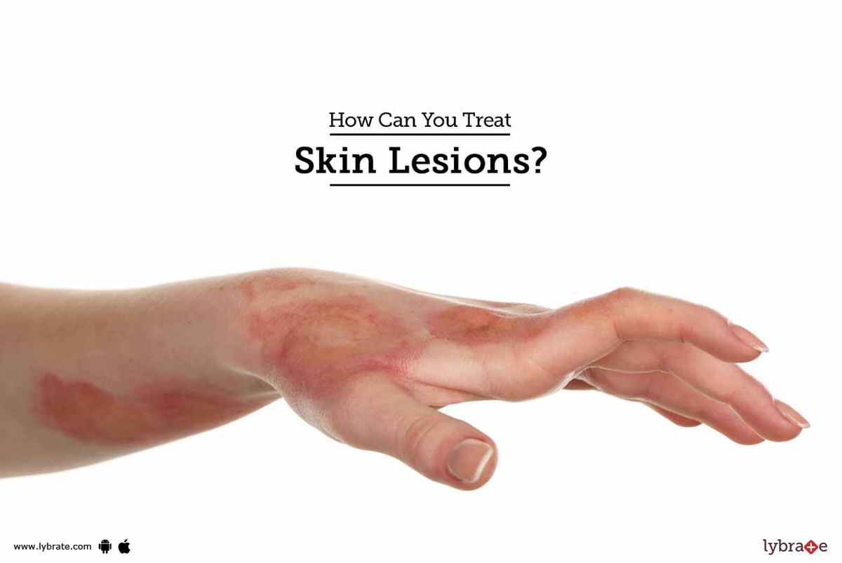 How Can You Treat Skin Lesions? - By Dr. M.P.S Saluja | Lybrate