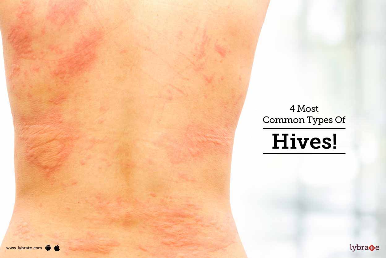 4 Most Common Types Of Hives! By Dr. Vijay Gupta Lybrate