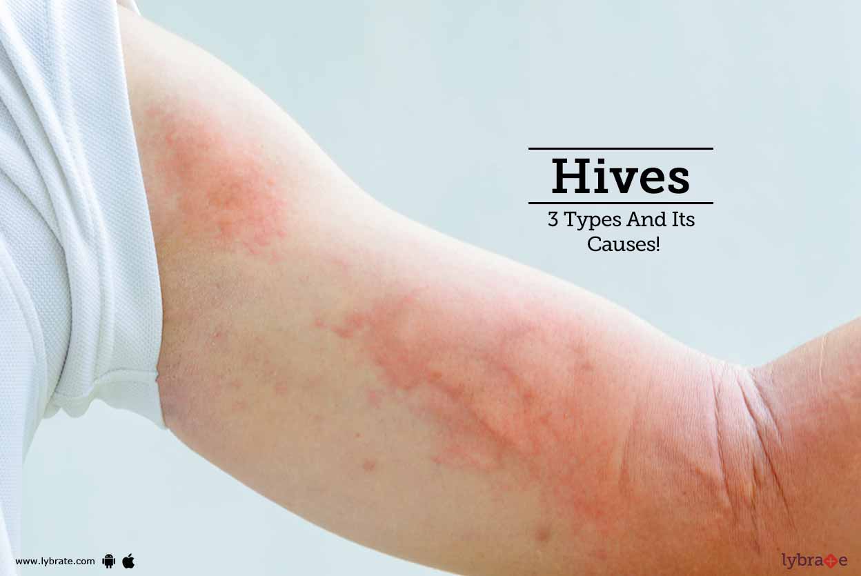Hives 3 Types And Its Causes By Dr Sunil Menon Lybrate