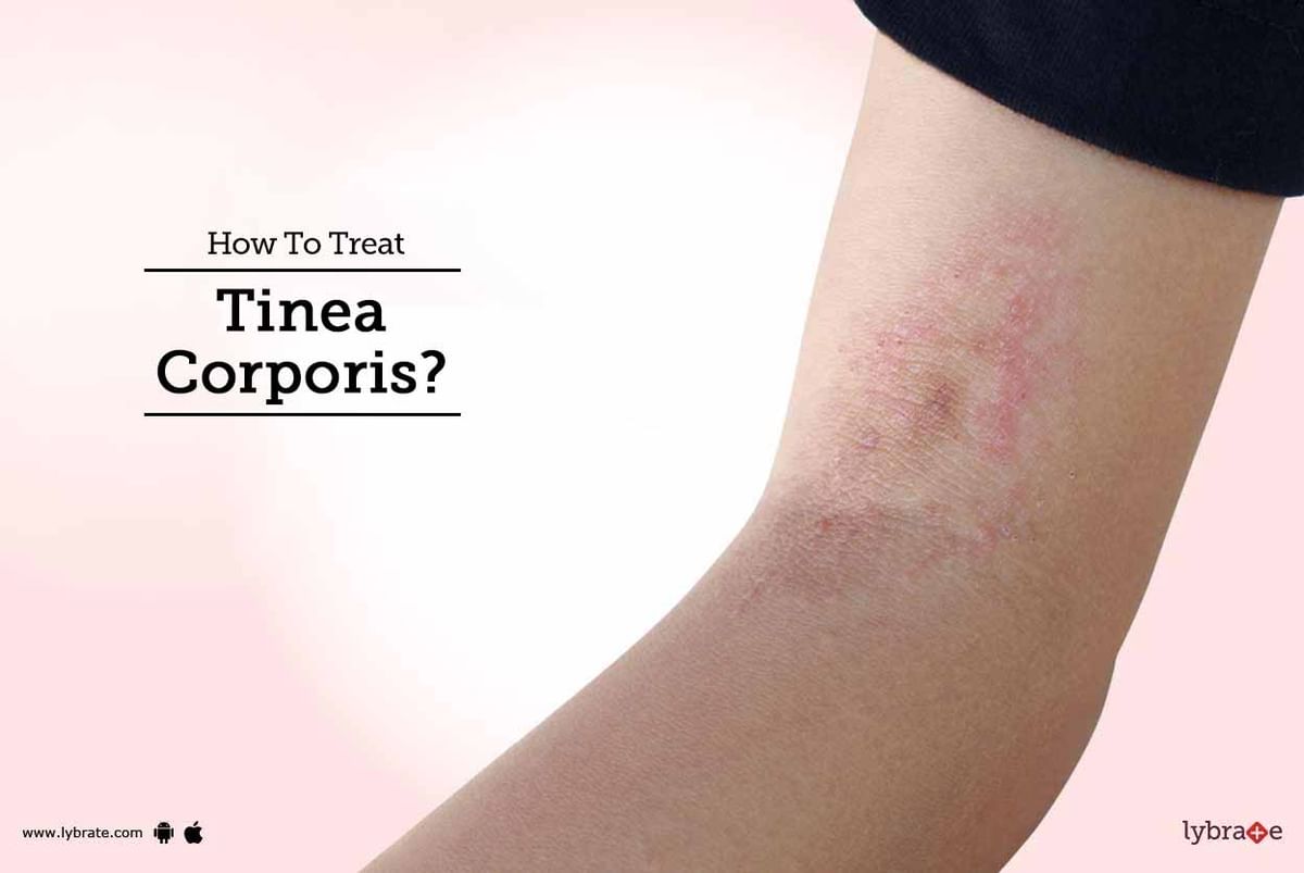 How To Treat Tinea Corporis? - By Dr. Rahul Balmiki