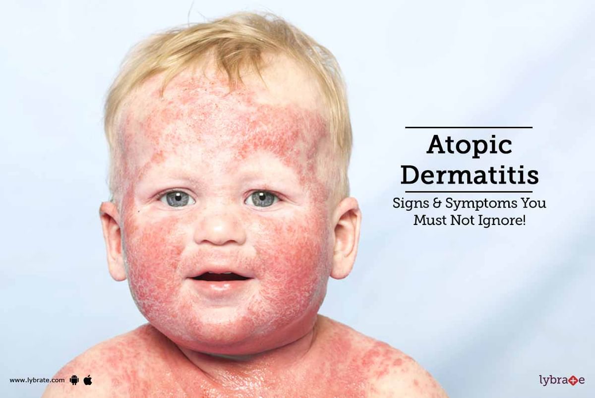 Atopic Dermatitis Signs & Symptoms You Must Not Ignore! By Dr